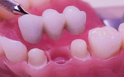 Dental Bridges: What Can They Do For You?
