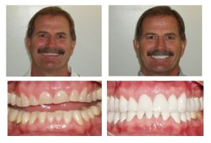 A before and after dental crown of a male patient 