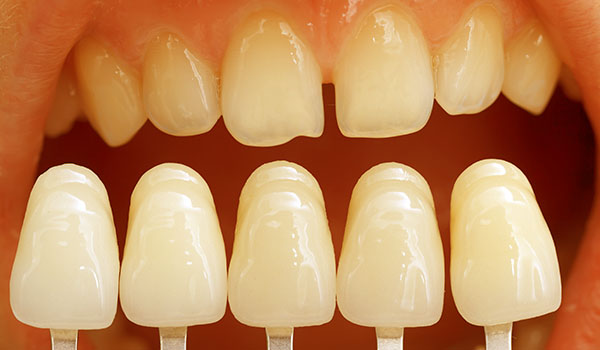 What Can Dental Veneers Do for You