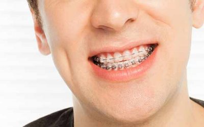 How to Eliminate Bad Breath When You Have Braces