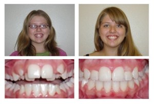 A before and after orthodentics photo of a female patient: left - female smiling with glasses and crooked teeth, right - female smiling straight teeth 