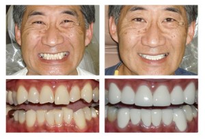 A before and after putting porcelain crowns on an old male patient: Left- yellow, chipped, miasaligned teeth, Right - straightened white teeth