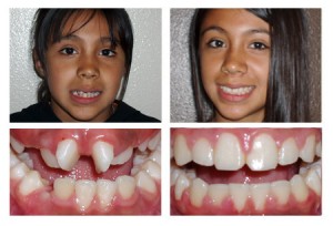 Comparison photo of before and after orthodentic procedure on a female patient: left - crooked teeth with gaps in between, right - aligned teeth with pink gums
