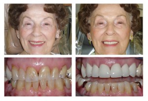 A before and after putting porcelain crowns on an old female patient: Left- yellow damaged teeth, Right - white teeth