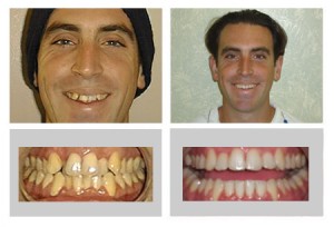 A before and after orthodentic procedure on a male patient: Left- crooked yellow teeth, Right - straightened white teeth