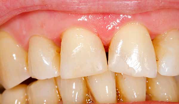 What are Your Treatment Options for Gum Disease