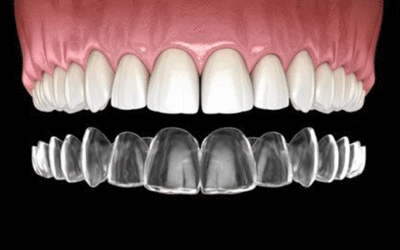 Top 3 Reasons People Choose Invisalign Over Traditional Braces