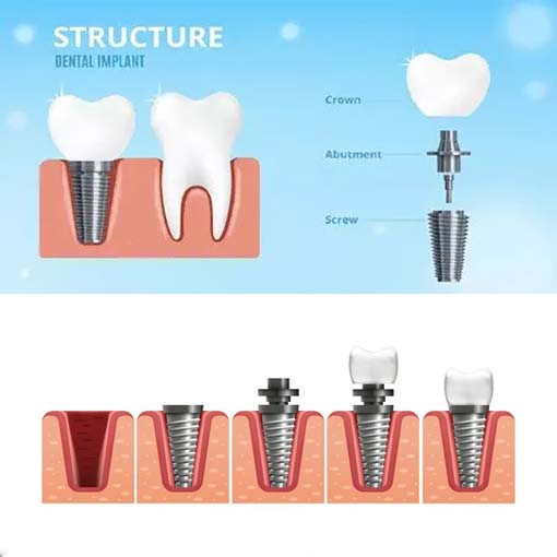 what are exactly dental implant