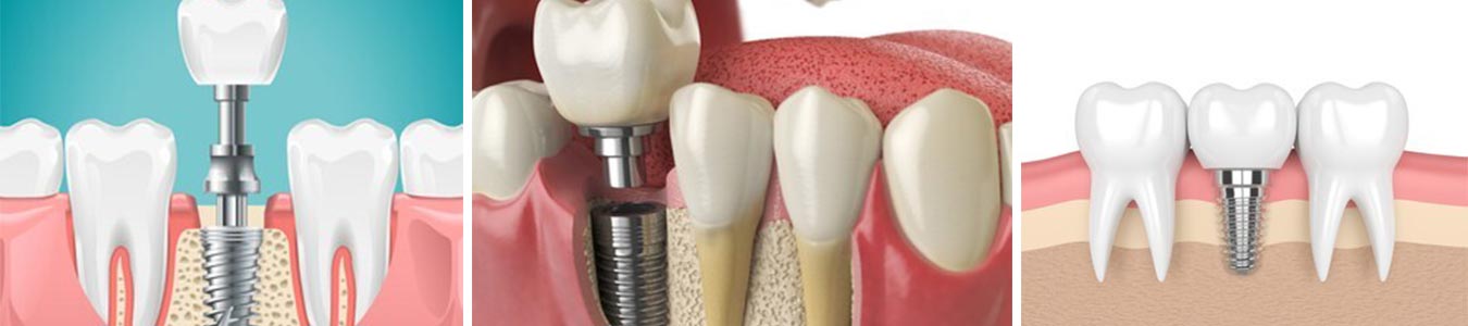Best Dental Implant Service in Fontana, CA