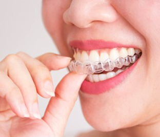 Invisalign - Your Dentist in Fontana, CA and Surrounding Areas