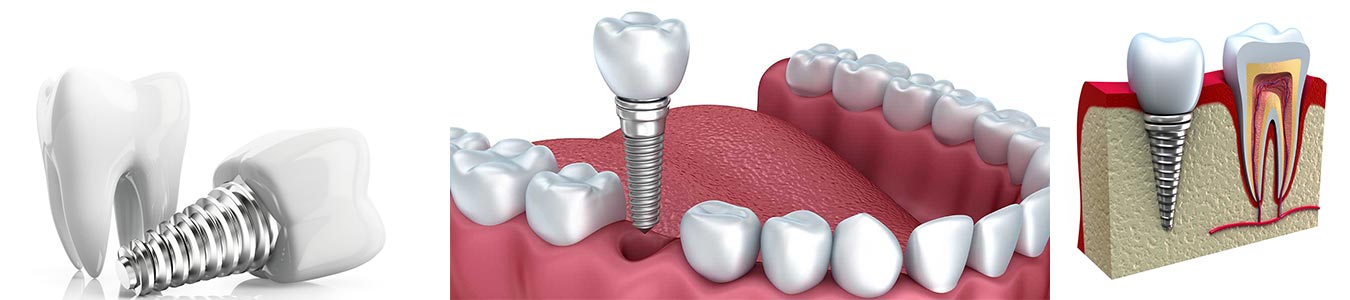 Best Dental Implant Dentist In Fontana, CA