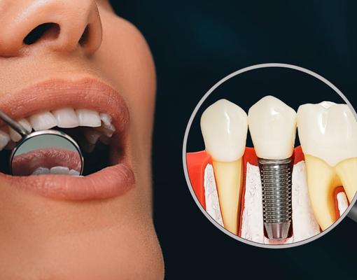 Dentist checking womens teeth with dental implant model