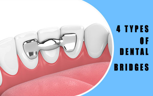 There are 4 types of Dental Bridges