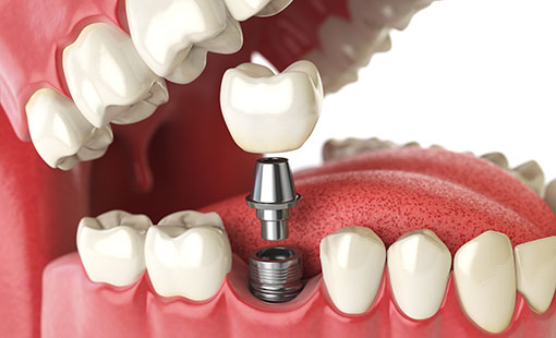 Dental Implant Benifits