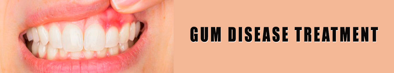 Gum-Disease-Treatment-In-Fontana-CA