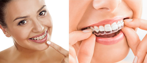 Invisalign vs Braces which one is better ?