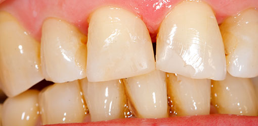 Stained-or-Discolored-teeth