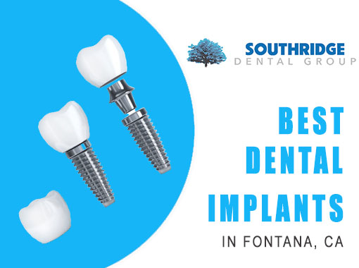 Best dental implants in fontana ca