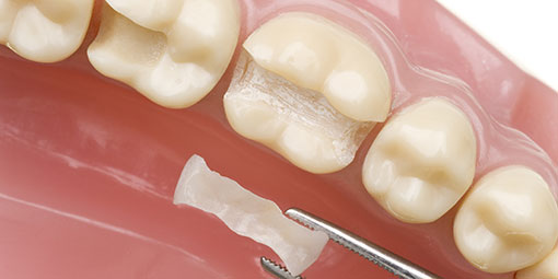 Veneers can be used for slightly crooked teeth