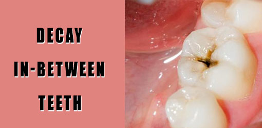 Teetf Decay In-Between teeth