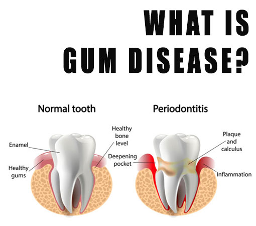 Best place to get Gum Disease Treatment In Fontana CA