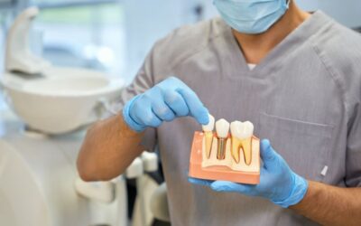 Top 5 Reasons People Choose Dental Implants Over Bridges and Dentures