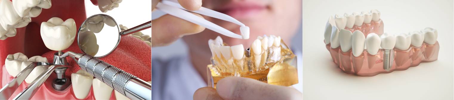 dental implant models