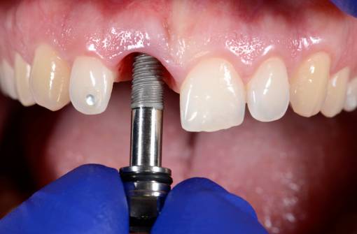 someone inserting a metal used for implant in the gums