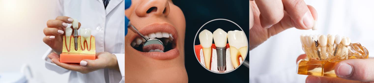 Dental Implant models