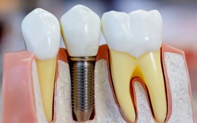 Types Of Dental Implants (Which Is Right For You)