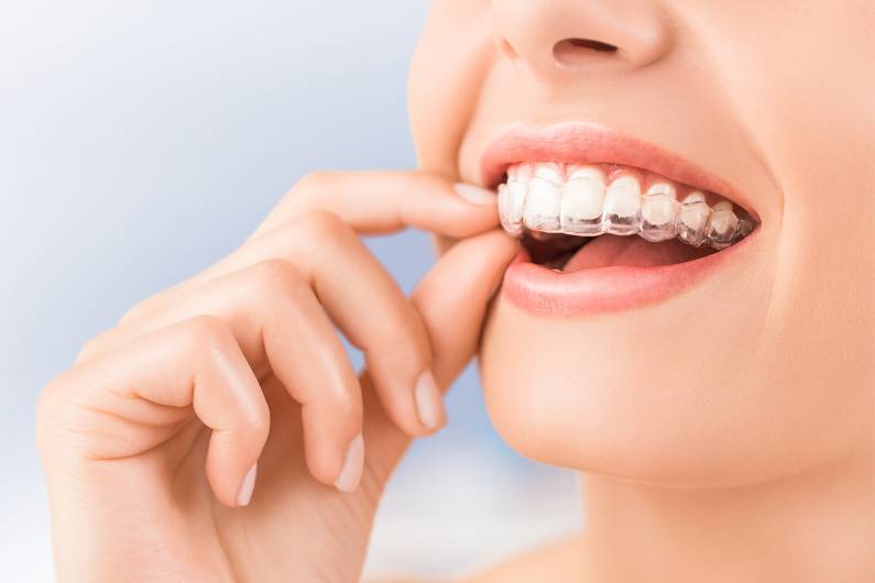 Why So Many People Are Turning To Invisalign To Straighten Their Teeth