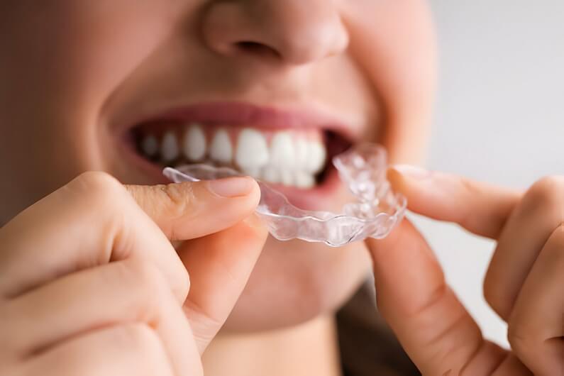 Invisalign vs. Traditional Braces: Making the Right Choice